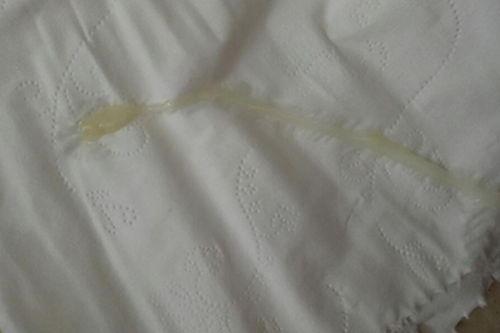 女性白带正常图片,女性白带正常形态图解与概述